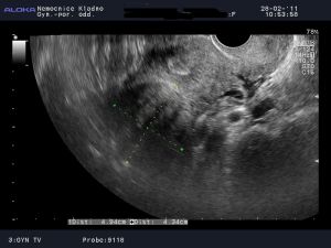 thumb ultrazvuk