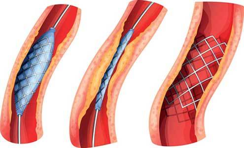 perkuatana angioplastika